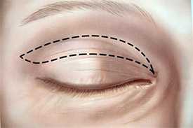 Пластические операции блефаропластика (пластика век)